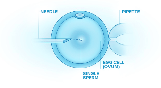 Intracytoplasmic-sperm-injection