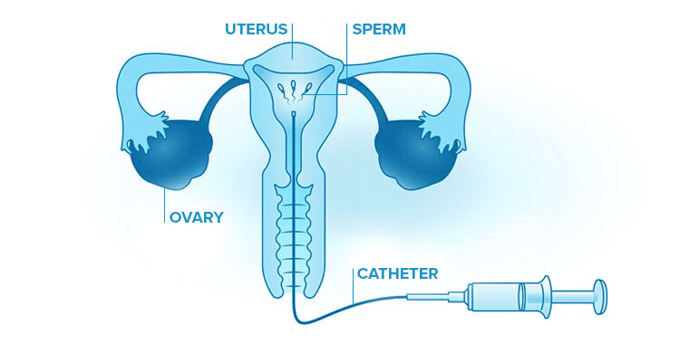 Intrauterine Semination