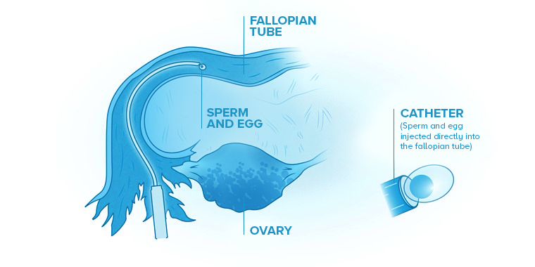 Gamete intrafallopian transfer