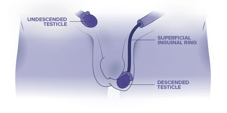Undescended Testicals